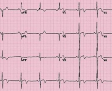 ECG